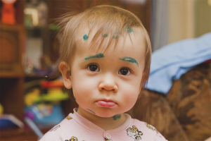 Come trattare la varicella nei bambini