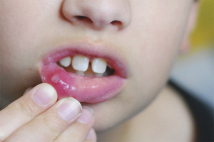 Como tratar la estomatitis en un niño