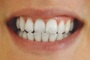 Comment blanchir les dents avec du soda