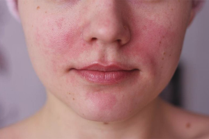 Cara menghilangkan rosacea pada wajah