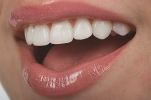 Comment renforcer les dents si elles tombent en panne