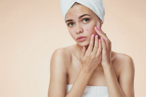 Acne ormonale nelle donne