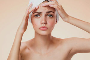 Acne sulla fronte nelle donne