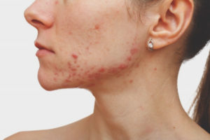 Acne sul mento nelle donne