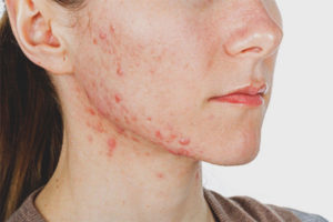 Acne sugli zigomi delle donne