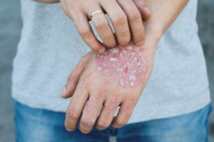 Como tratar la psoriasis