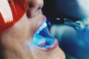 Blanchiment des dents au laser