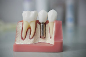 Implante dental