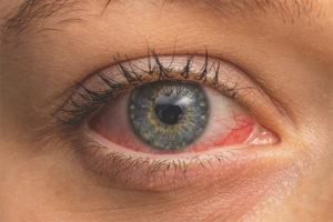 conjuntivitis